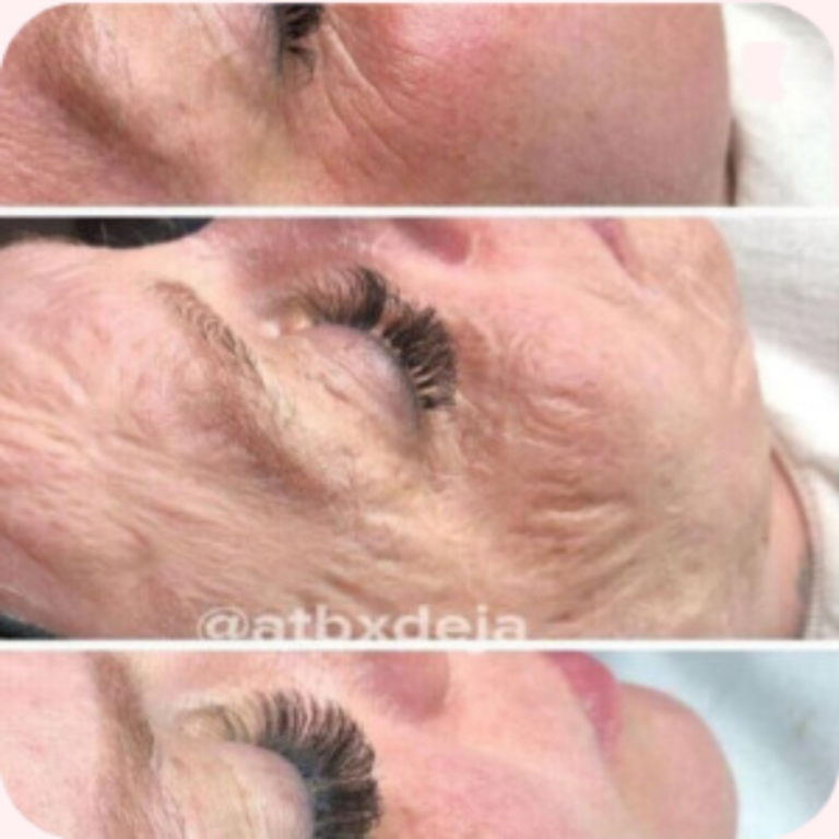 Masque Contouring (Botox)